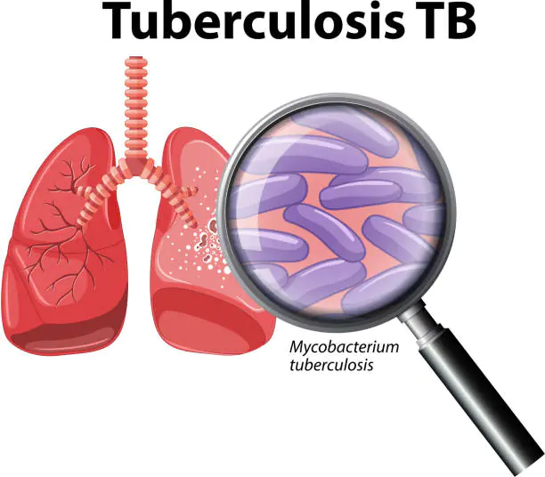 A comprehensive approach to molecular diagnostics of drug-resistant and extensively drug-resistant tuberculosis with the development of an information-analytical system for personalized medicine and epidemiological surveillance