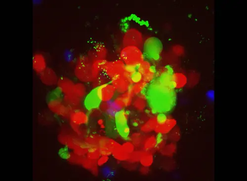 Heterotypic 3D models of human breast and brain tumors for the study of tumor-stroma interaction and the development of new therapeutic approaches