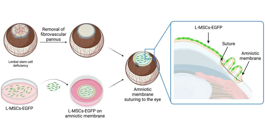Трансплантация стволовых клеток запустила восстановление роговицы